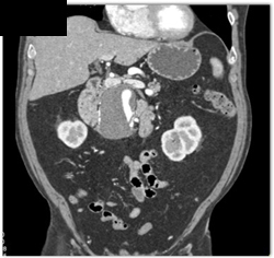 SMA Aneurysm - CTisus CT Scan