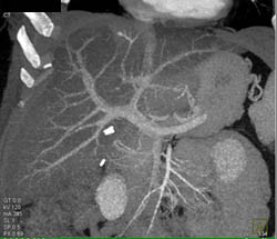 Fatty Liver - CTisus CT Scan