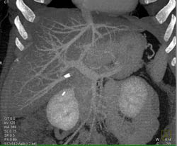 Fatty Liver - CTisus CT Scan