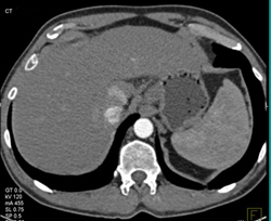 Vascular Lesion Near IVC - CTisus CT Scan