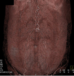 Abdominal Wall Varices Due to Cirrhosis - CTisus CT Scan