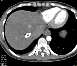 Regenerating Nodules - CTisus CT Scan