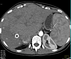 Regenerating Nodules - CTisus CT Scan