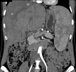 Regenerating Nodules - CTisus CT Scan