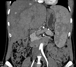 Regenerating Nodules - CTisus CT Scan