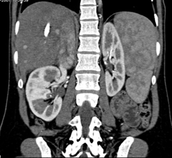 Regenerating Nodules - CTisus CT Scan