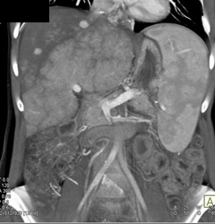 Regenerating Nodules - CTisus CT Scan