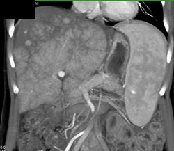 Regenerating Nodules - CTisus CT Scan