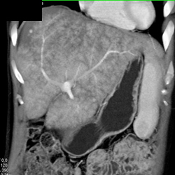 Budd-Chiari and Regenerating Nodules - CTisus CT Scan