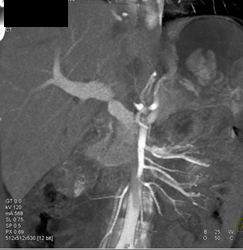 Narrowed Portal Vein (PV) S/P Transplant - CTisus CT Scan