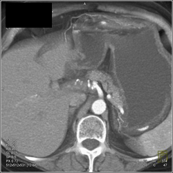 Hepatic Aa Aneurysm - CTisus CT Scan