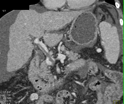 Partial Portal Vein Thrombosis (PVT) - CTisus CT Scan