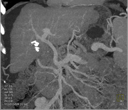 Portal Vein Thrombosis (PVT) Missed on MIP Images and Seen on VRT - CTisus CT Scan