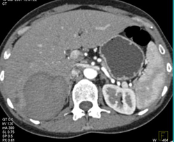 Hematoma - CTisus CT Scan