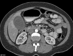 Perfusion Changes Around Gallbladder - CTisus CT Scan