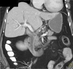 Dilated Common Bile Duct (CBD) Due to Ampullary Stenosis - CTisus CT Scan