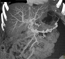 Portal Vein Thrombosis With Collaterals - CTisus CT Scan