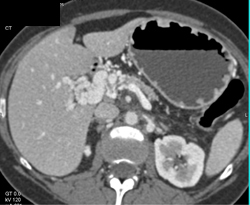 Cavernous Transformation of the Portal Vein (CTPV) - CTisus CT Scan