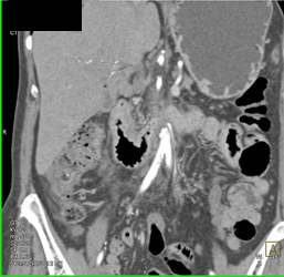 Ampullary Cancer - CTisus CT Scan