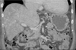 Fatty Liver - CTisus CT Scan