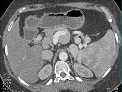 Portal Hypertension With Varices and Splenic Artery Aneurysms - CTisus CT Scan