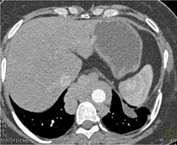 Paraesophageal Varices - Liver Case Studies - CTisus CT Scanning