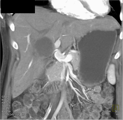 Cystic Lesion Liver Located Near the Porta Hepatis With A Range of Renderings - CTisus CT Scan