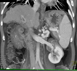 Cirrhosis With Partial Portal Vein Thrombosis - CTisus CT Scan