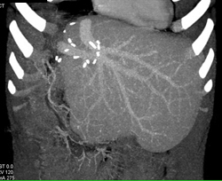 Pseudo Lesion Liver Simulates Recurrent Tumor on Early Phase Images - CTisus CT Scan