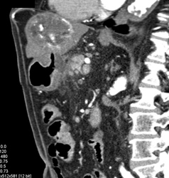 Hepatoma and Gastric Invasion With Fistulae - CTisus CT Scan