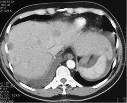 Liver Metastases From Bladder Cancer - CTisus CT Scan