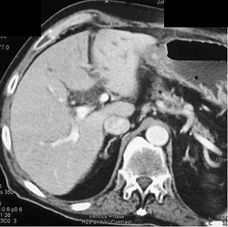 Dilated Common Bile Duct (CBD) - CTisus CT Scan