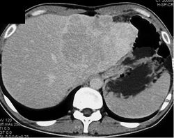 Hepatoma With Perfusion Changes - CTisus CT Scan