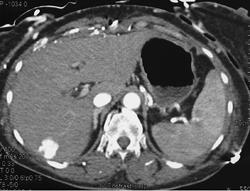 Hepatic Hot Spots Due to SVC Occlusion - CTisus CT Scan