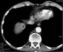 Metastatic Carcinoid Tumor - CTisus CT Scan