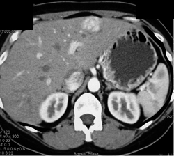 Focal Nodular Hyperplasia (FNH) - CTisus CT Scan