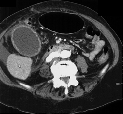 Gallbladder Cancer Presents as Acute Cholecystitis - CTisus CT Scan