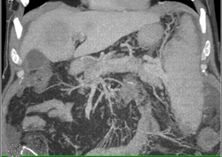 Hepatoma - CTisus CT Scan