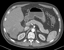 Liver Metastases on Venous Phases of Acquisition - CTisus CT Scan