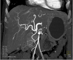 Hepatoma - CTisus CT Scan