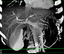 Cholangiocarcinoma Invades the Left Portal Vein - CTisus CT Scan