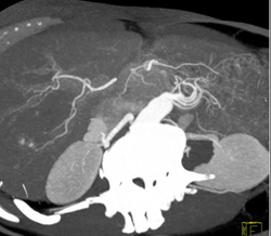 Av Shunting - CTisus CT Scan