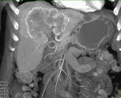 Hematoma With Neovascularity - CTisus CT Scan