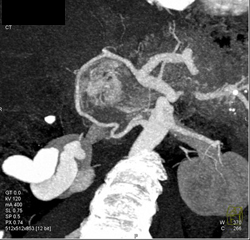 Islet Cell Tumor of the Pancreas Invades the Portal Vein With Impressive Collaterals - CTisus CT Scan