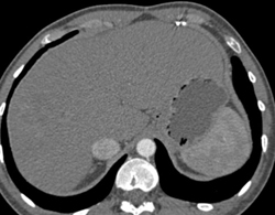 Subtle Vascularity Representing A Hepatoma in A Cirrhotic Liver- See Full Sequence - CTisus CT Scan