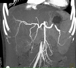 Hepatoma - CTisus CT Scan