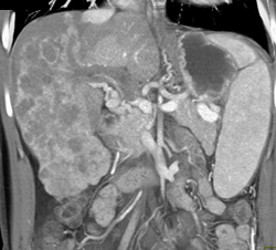 Hepatoma - CTisus CT Scan