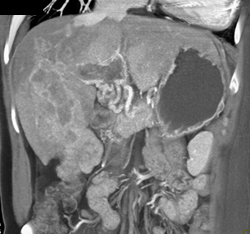 Hepatoma - CTisus CT Scan