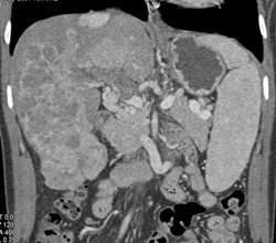 Hepatoma - CTisus CT Scan