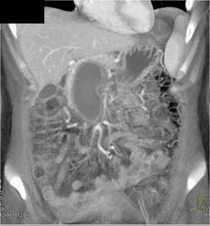 Portal Vein Thrombosis With Collaterals and Incredible Size of PVT - CTisus CT Scan